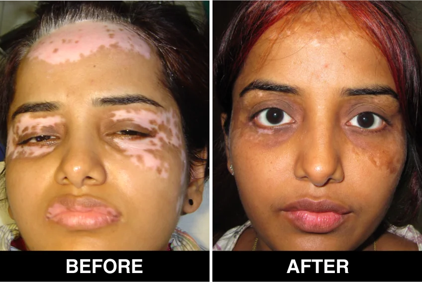 Vitiligo Milestone
