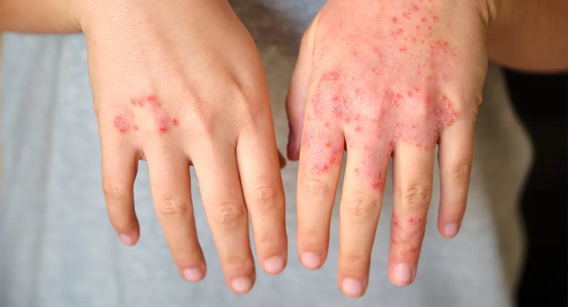 Eczema Care