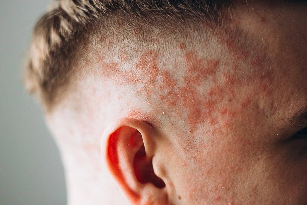 Eczema Condition Example