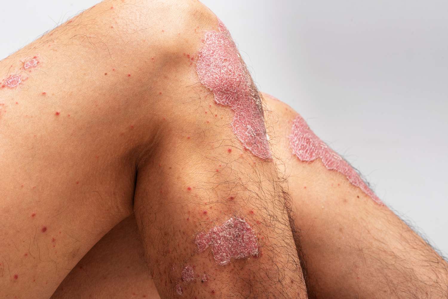 Psoriasis Treatment