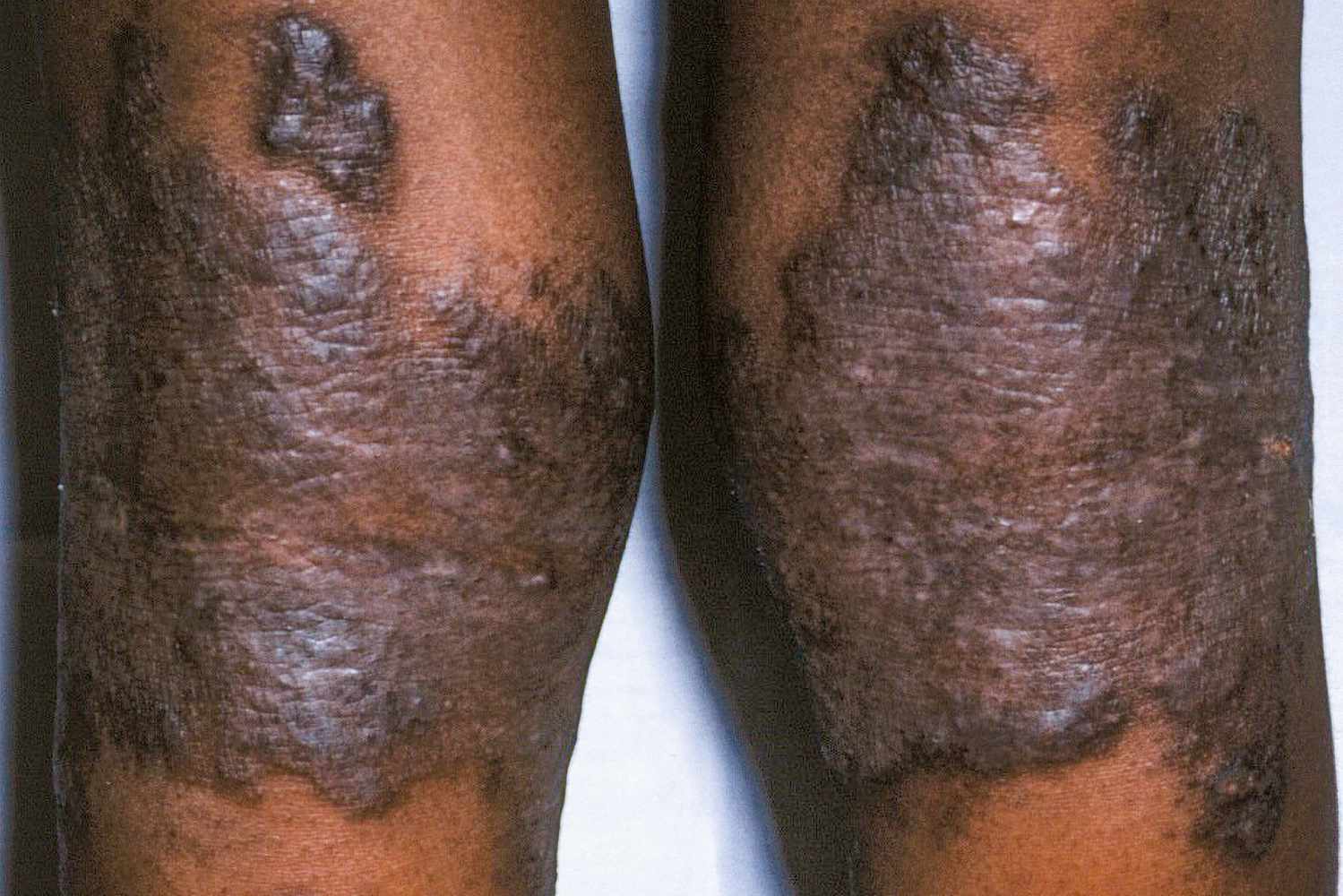 Chronic Disease Management