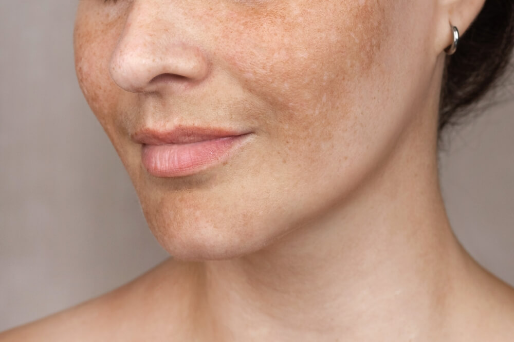 Pigmentation Cure