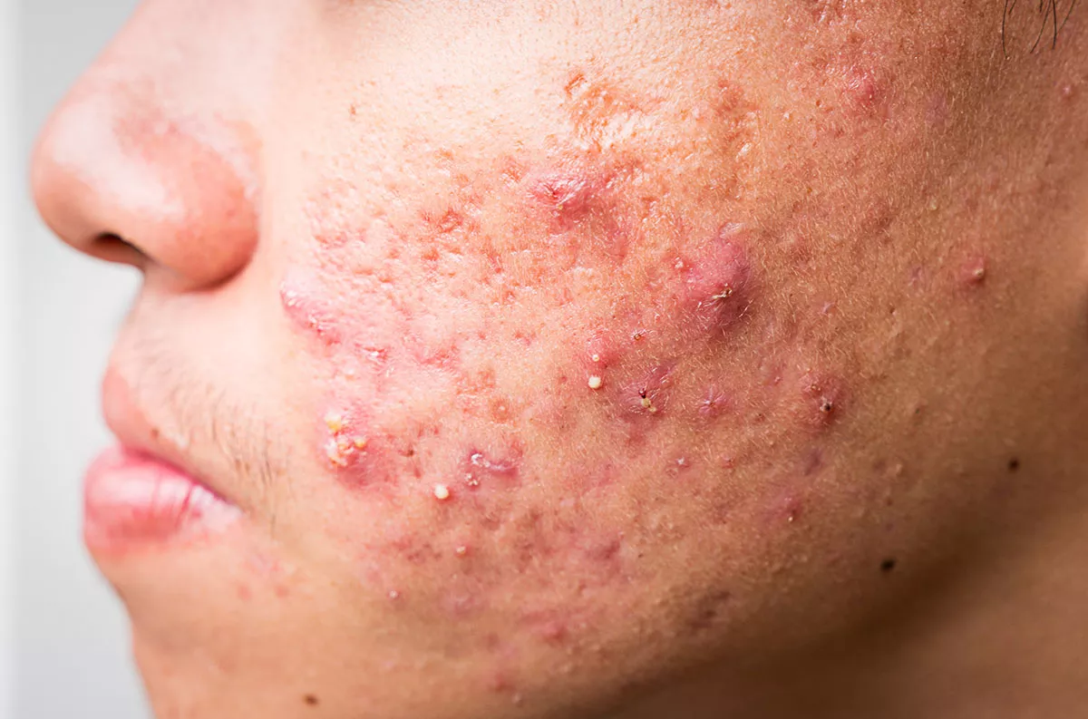 Acne Care