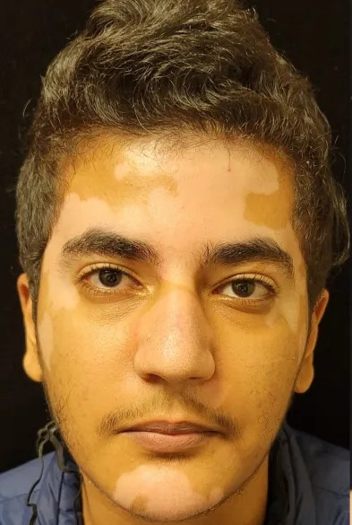 Vitiligo Before