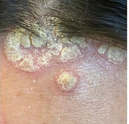 Psoriasis Before