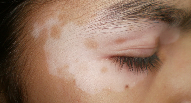 Leucoderma Recovery