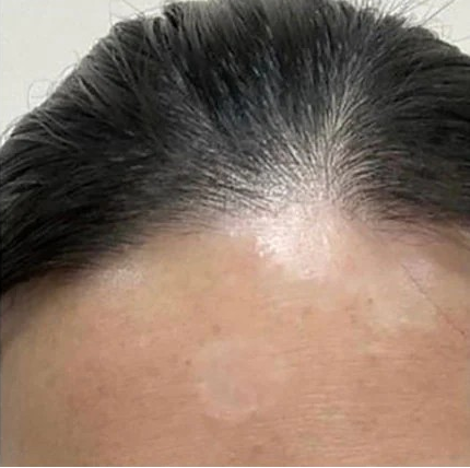 Psoriasis After