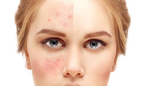 Acne Prevention Tips