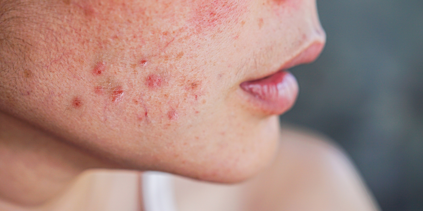 Acne Symptoms Overview