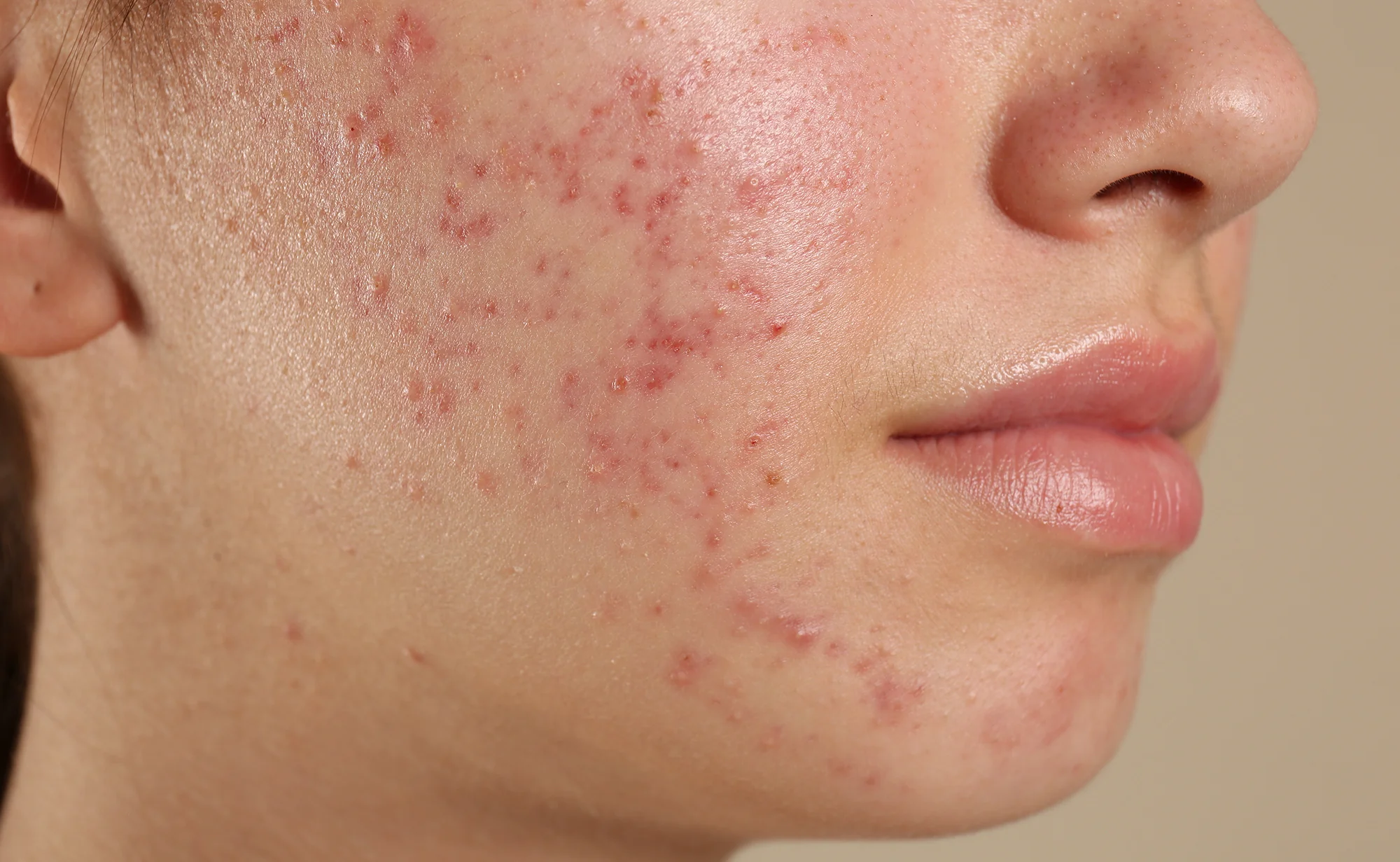 Healthy Lifestyle for Acne