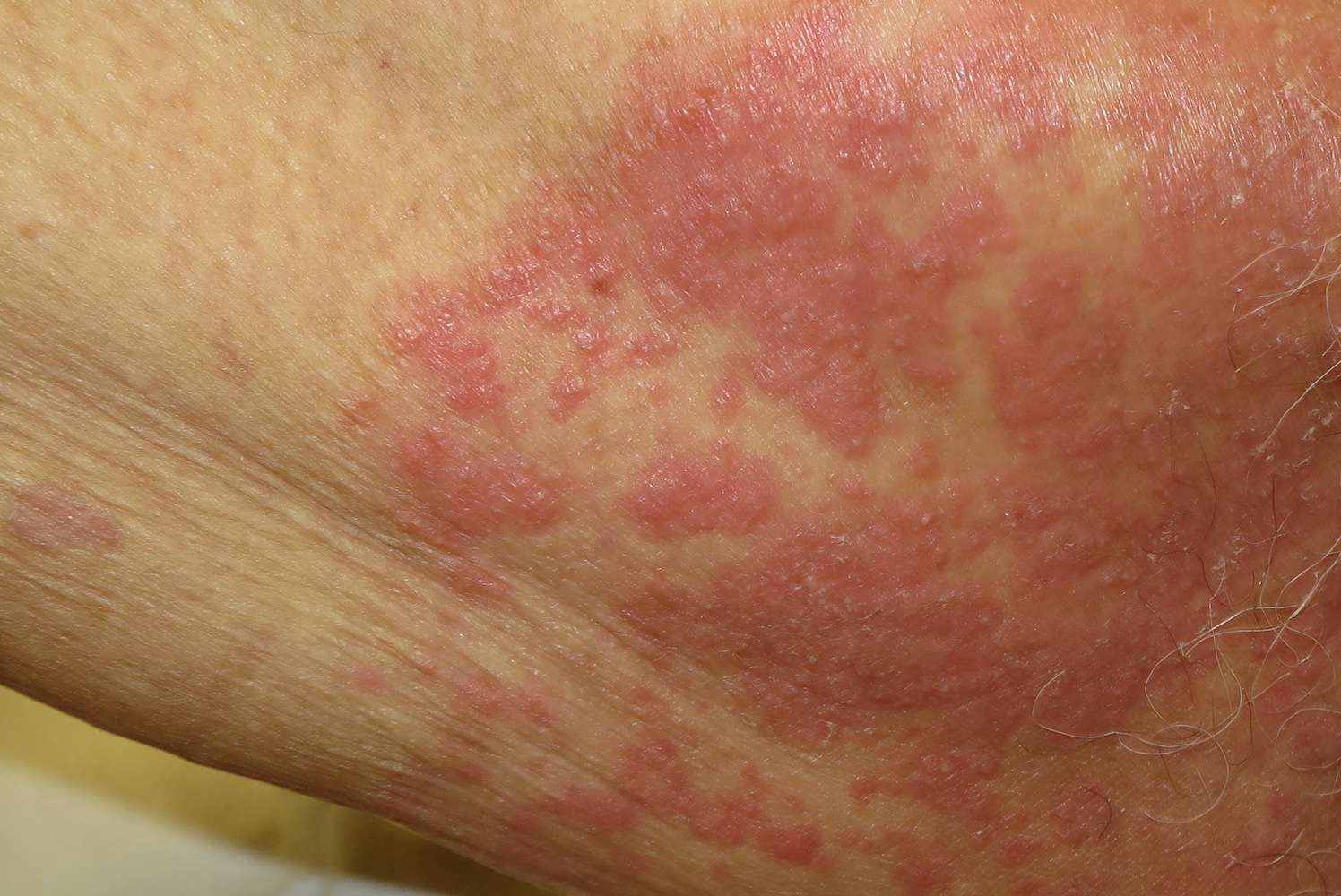 Fungal Symptoms