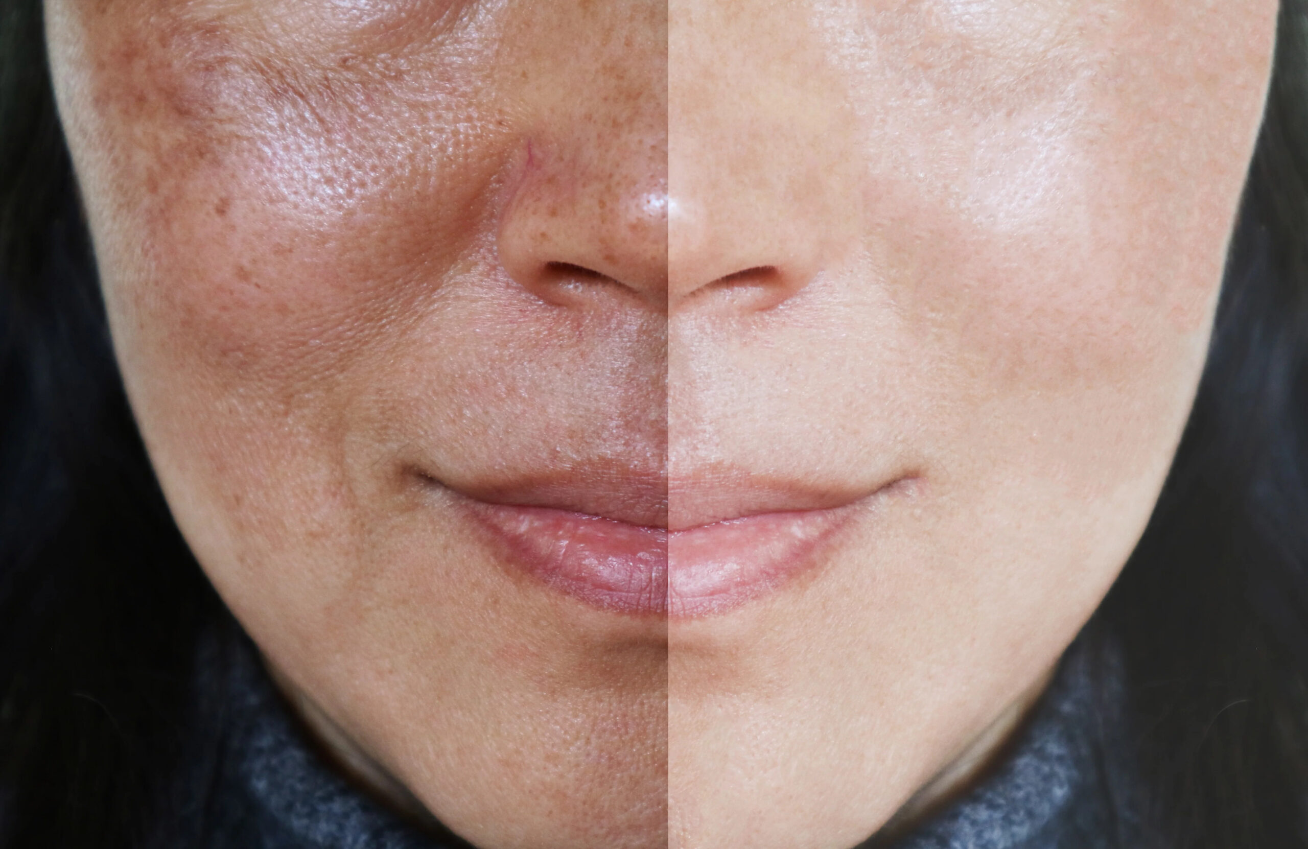 Uneven Skin Tone Overview