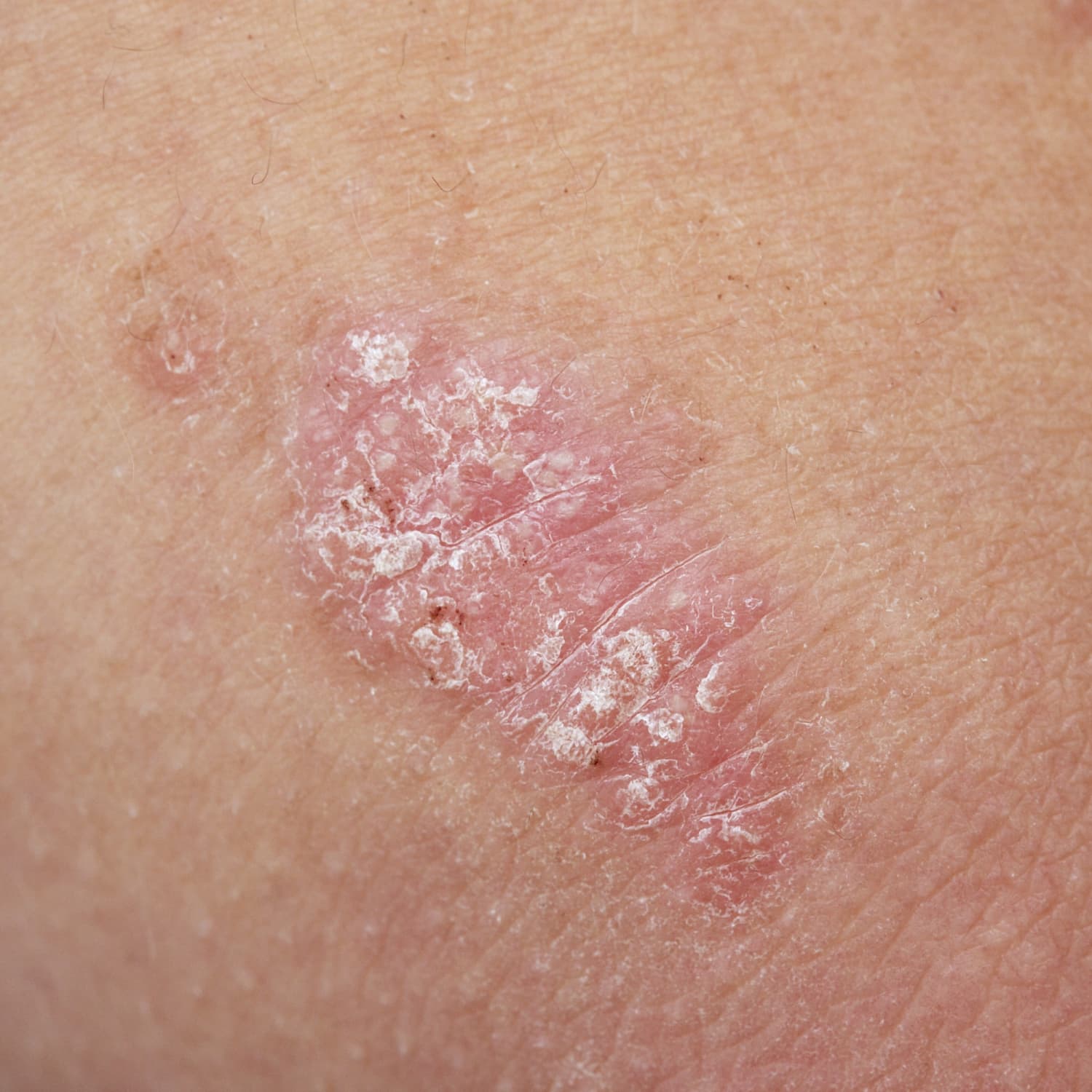 Psoriasis Plaques